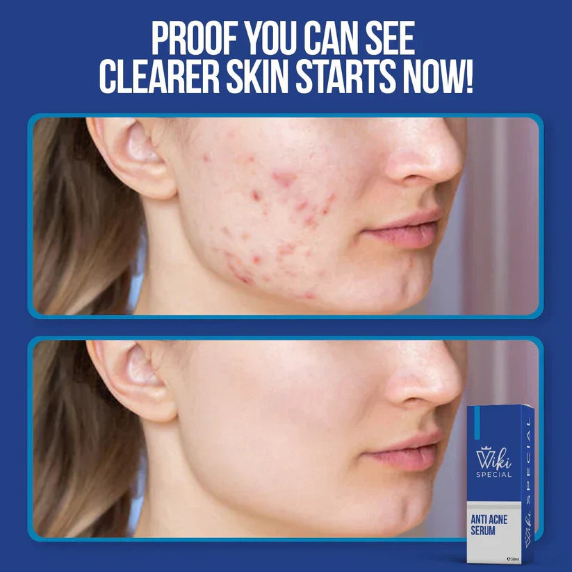 ✨ Wiki Special 100% Original Anti Acne Serum – Clear, Calm & Confident Skin